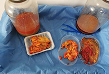 谁说奥美定少量根本不用取出？我来告诉你奥美定不取出来会怎样？