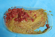 谁说奥美定少量根本不用取出？我来告诉你奥美定不取出来会怎样？