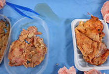 “奥美定”隆胸16年后乳腺病变