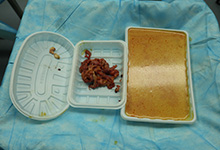 “奥美定”隆胸16年后乳腺病变