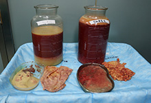 全面解析：奥美定取出处理最佳开口位置选择