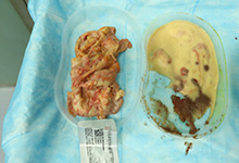 奥美定的危害有哪些